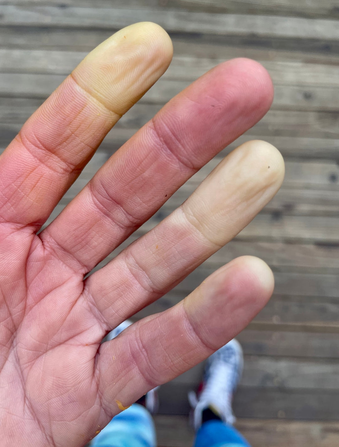 Picture of Raynaud's hand with cold, white fingertips